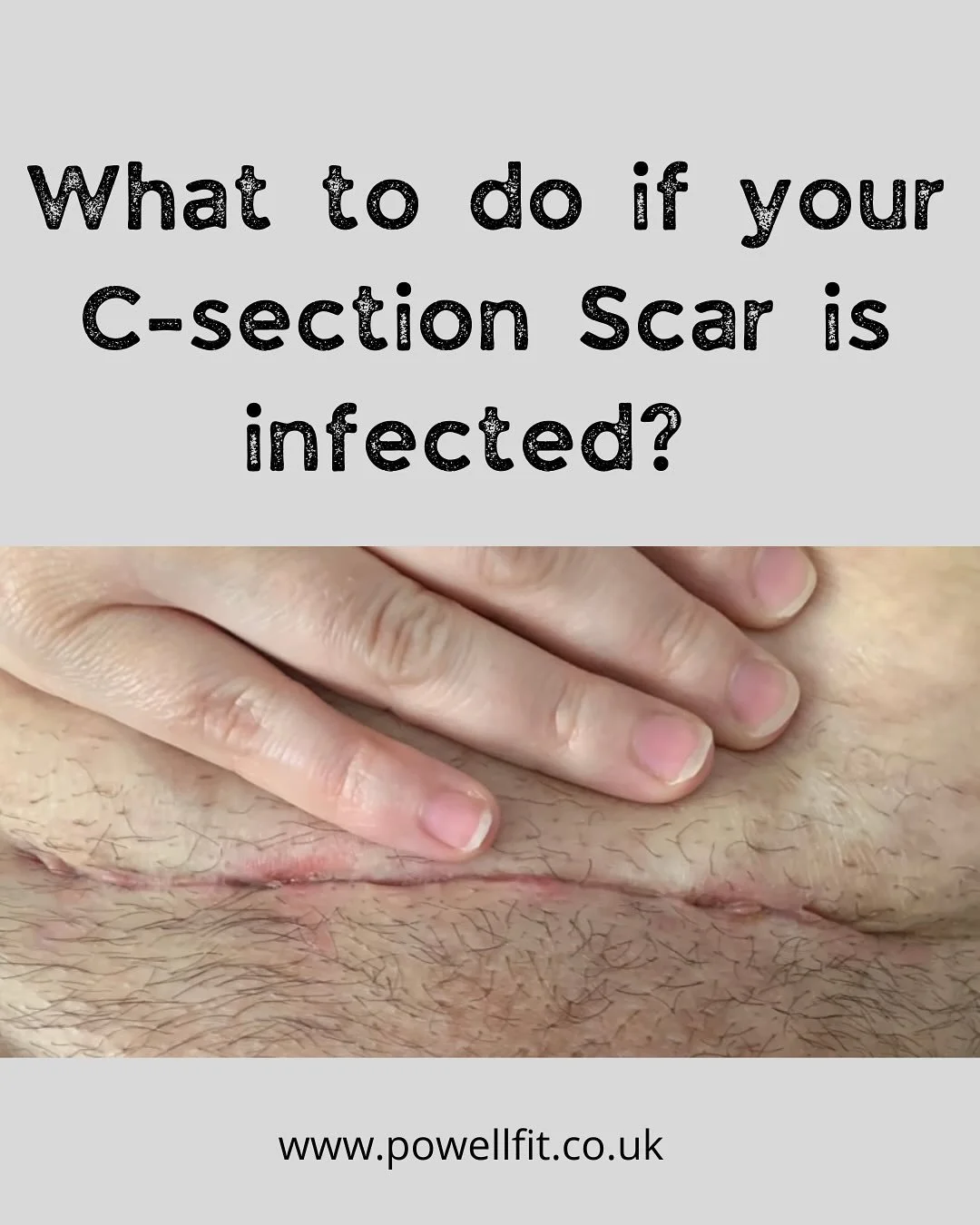 🤒 SO WHAT TO DO IF YOUR C-SECTION SCAR IS INFECTED? 🦠

If you ever suspect your scar might be infected &mdash; always contact your GP or healthcare provider!
It can be tempting to &ldquo;wait it out,&rdquo; but infections need to be checked quickly