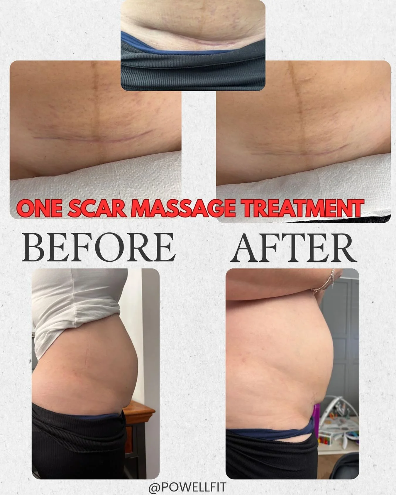 ✨ Another amazing before &amp; after &mdash; after just ONE scar treatment! ✨

I honestly can&rsquo;t stress enough how powerful and transformative scar therapy can be! 💫

This lovely mama came to see me with a tight C-section scar &mdash; especiall