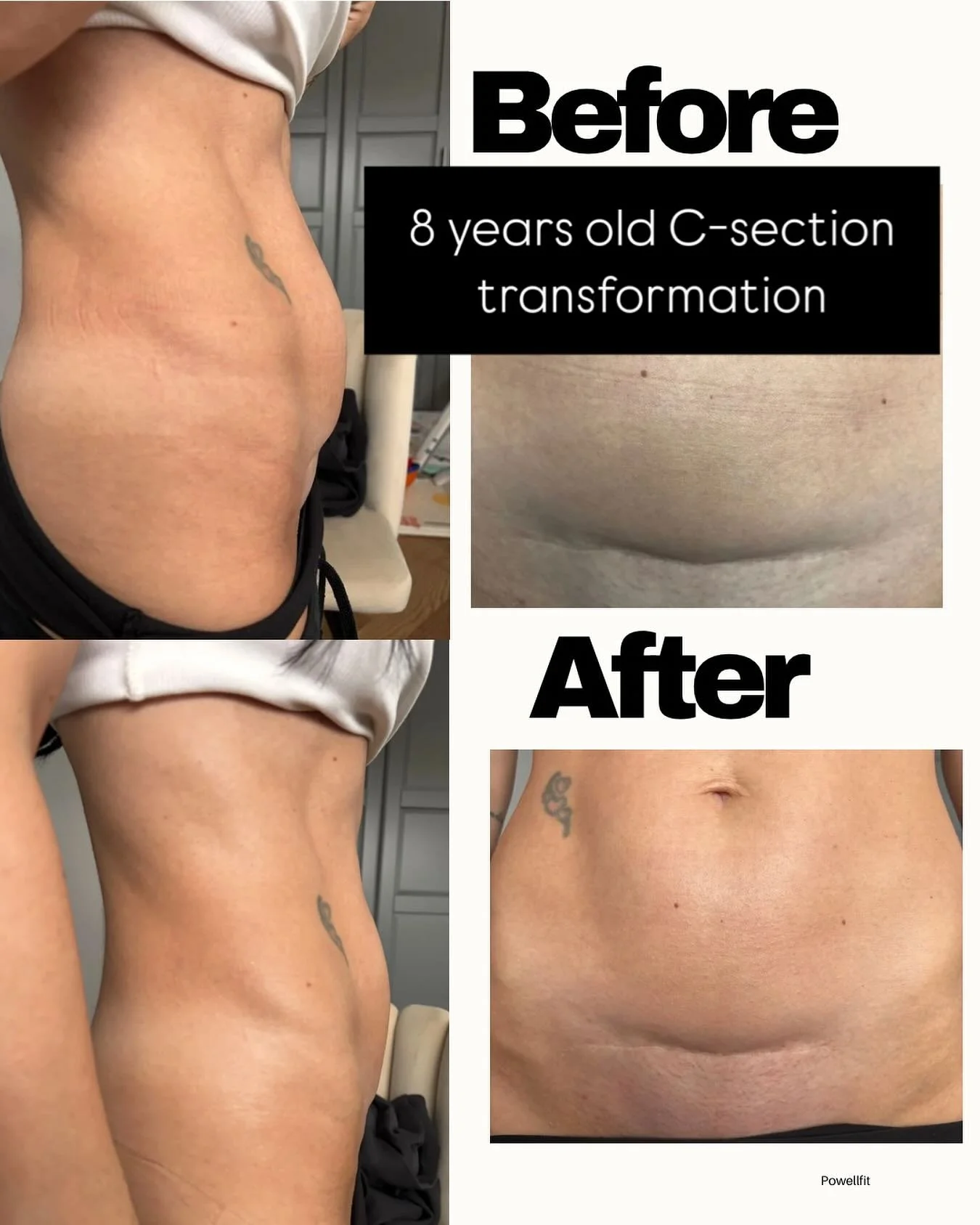 This one&rsquo;s for you, mamma, who had your C-section years and years ago! 💫

This lovely mamma of two had her C-sections 12 &amp; 8 years ago and came to me feeling some tightness and lumpiness around her scar, which created a little shelf.

Usin