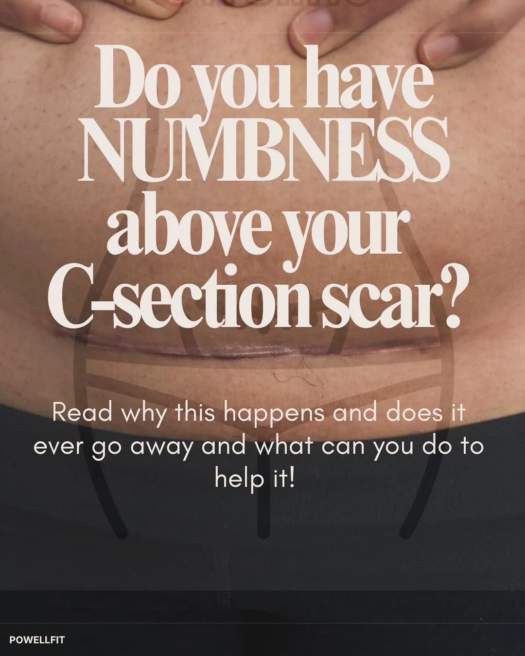 Do you have a NUMB C-section scar?

You&rsquo;re not alone, mamma. ✨
That strange numb, disconnected feeling is so common after a C-section &mdash; and it deserves to be spoken about.

Let&rsquo;s talk:

💭 Is your scar still numb?
💭 If it improved,