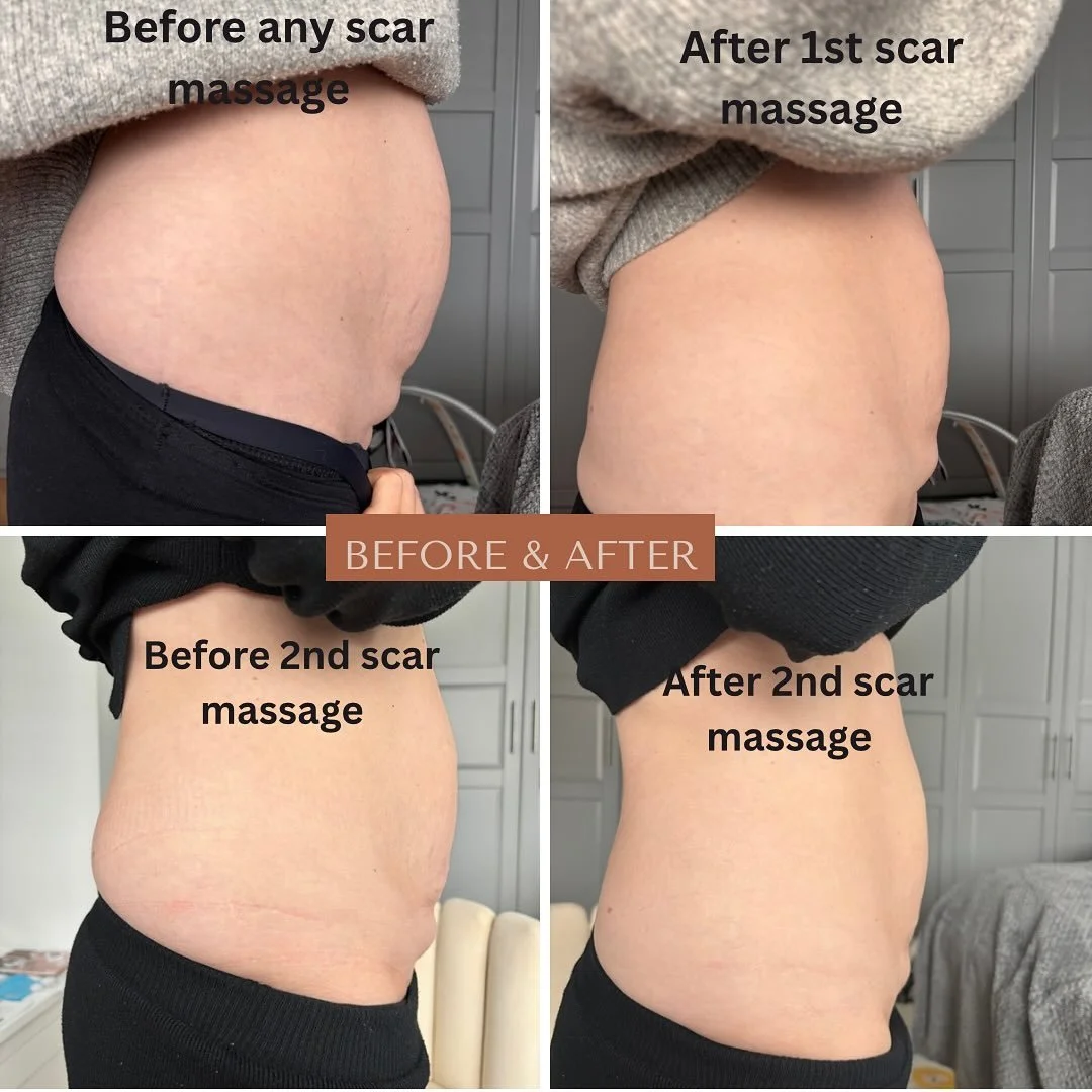 TRANSFORMATION posts are my favourite &mdash; and here&rsquo;s another gorgeous one!
Forever grateful when my clients kindly allow me to share their images 😘✨

This is another amazing before-and-after from recent scar massage sessions.
I always like