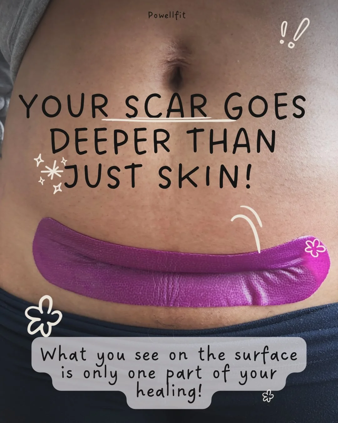 After a C-section, many women are told very little about their scar.
Understanding how your body heals &mdash; and why certain sensations are common &mdash; can be both reassuring and empowering.

A C-section involves multiple layers of the body, all