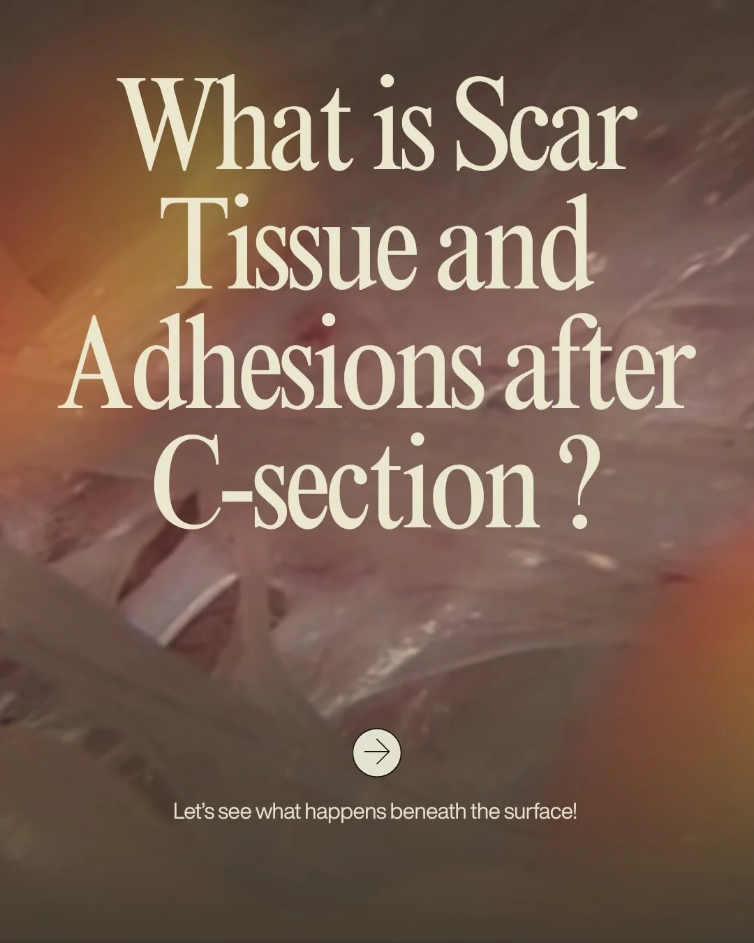 What is Scar Tissue &amp; Adhesions&hellip; and How They Can Affect Movement

Scar tissue is your body&rsquo;s natural repair system. Anytime tissue is cut, stretched, or inflamed (surgery, injury, or birth), your body lays down collagen to heal and 