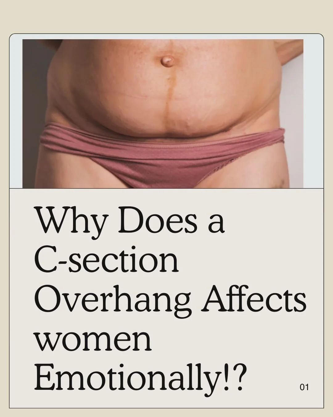 Does your C-section Scar and Overhang affect you emotionally ?? 

A C-section overhang is the fold or shelf of tissue that can sit above a C-section scar. It&rsquo;s incredibly common and not a reflection of effort, fitness, or doing anything wrong.
