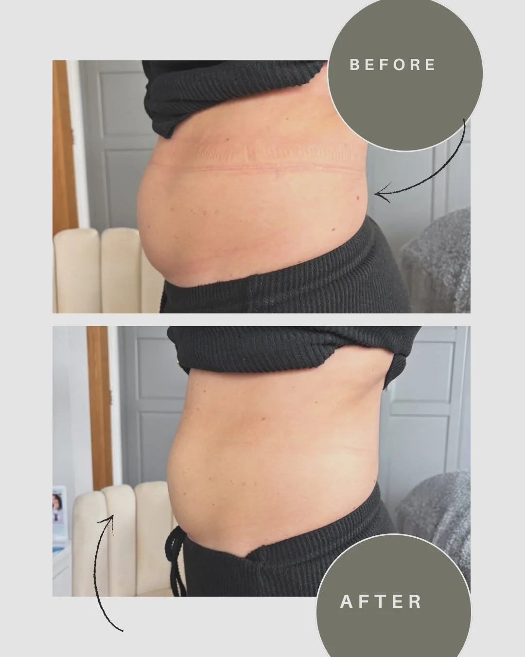 The power of tailored and targeted scar therapy ✨

With or without realising it, many women experience some fluid build-up around their scar after a C-section. Scar tissue can temporarily limit or redirect lymphatic flow, especially in the early stag