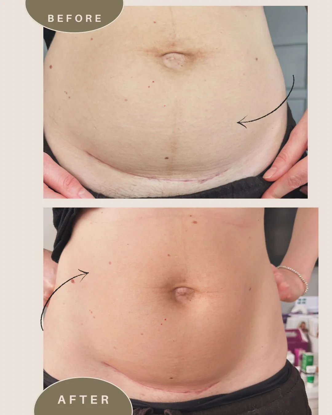 Another beautiful before &amp; after from a scar therapy session ✨

I always take the time to listen to your concerns and tailor each session to you.

This lovely mummy came in feeling tightness and puffiness around her tummy, so we combined targeted