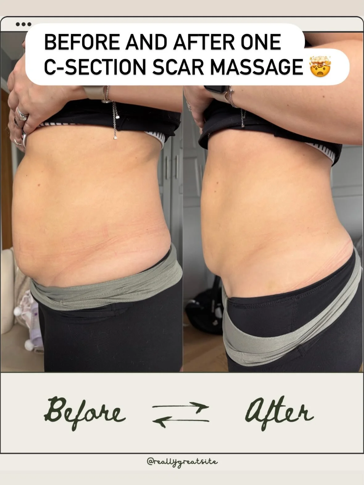 Amazing before &amp; after from just one scar therapy session ✨

This lovely mama came to me 14 weeks after her second C-section, with a scar that felt very tight and &ldquo;pinned down,&rdquo; alongside fluid retention, numbness, and birth trauma.

