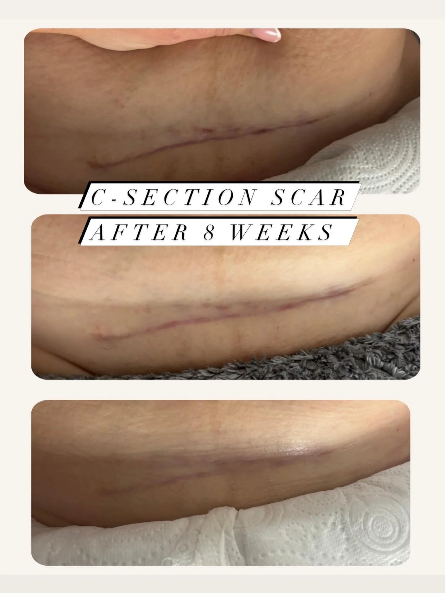 8 week scar transformation 🫶🏻🤍

Honestly&hellip; this is why I ❤️ what I do 🥹

This lovely mama came to me at the end of January after her second C-section, and just look at that change ✨

But it&rsquo;s not just about how it looks&hellip;

It&rs