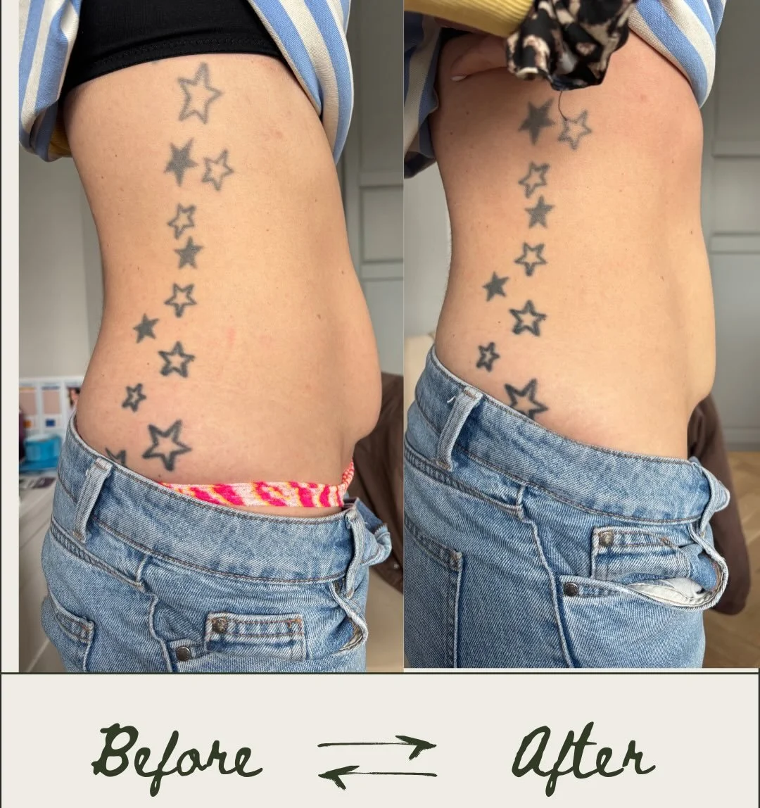 An another amazing scar massage before &amp; after ✨

Can you see the link here? This isn&rsquo;t a coincidence&hellip;

This is the power of scar massage 🤍

Every session I offer is completely bespoke to you. This can include targeted abdominal MLD