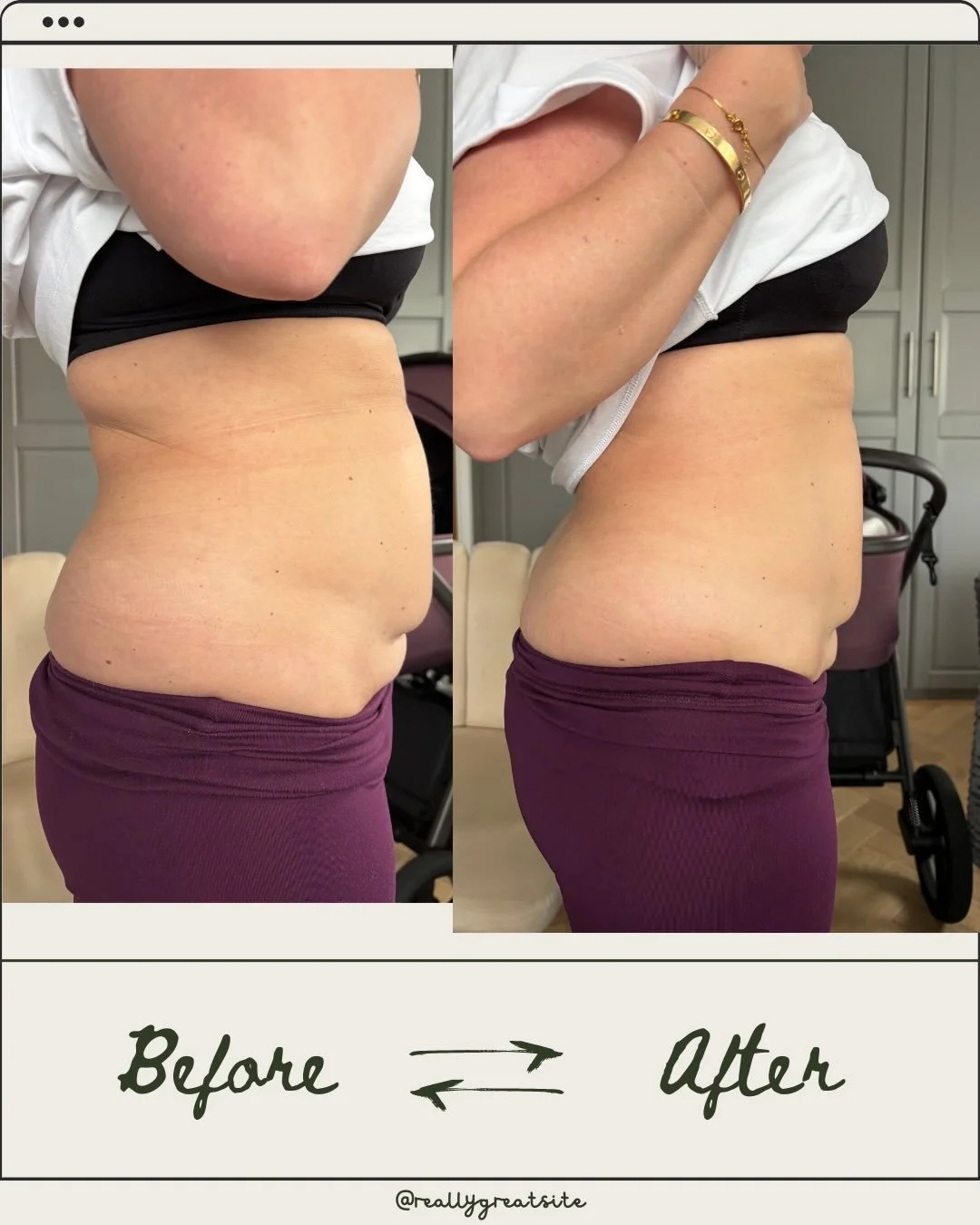 Just an another amazing transformation after the first Scar massage visit! 

This lovely mamma came to me 10weeks post c-section ,she experienced some tightness, pulling, numbness  and some fluid trapped above the scar making the shelf more apparent!