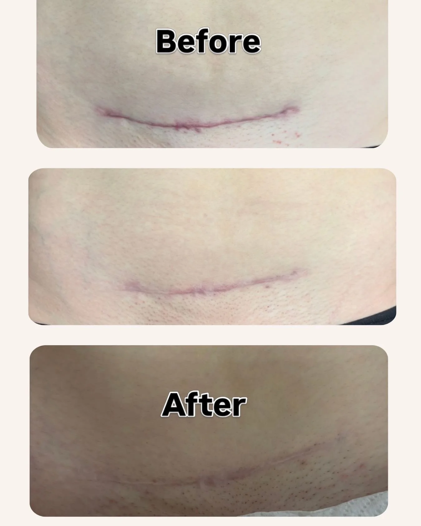 Another beautiful C-section scar transformation 🤍

This lovely mama came to see me at just 8 weeks post C-section (top image). Her scar was hypertrophic, tight, and lacking mobility.

Over the course of her recovery, we combined:
✨ Targeted scar mas