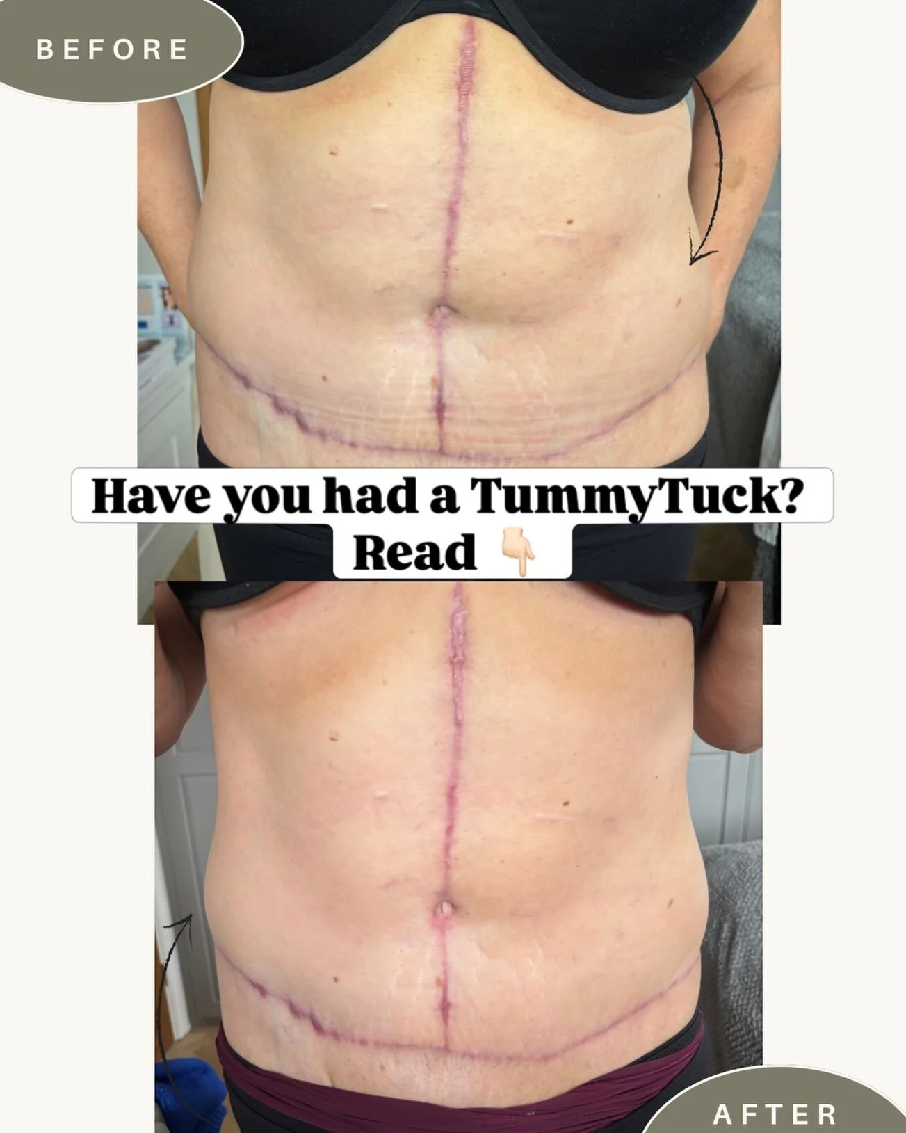 Lovely client of mine came to me 6 months after having a tummy tuck + FDL, mainly complaining of tightness&hellip;

But what we found was more than just tightness.

This scar was still highly vascular, reactive, and parts of it had become hypertrophi