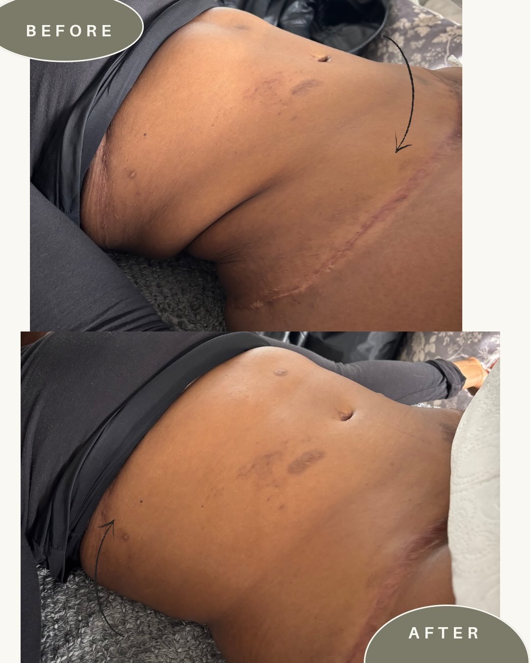 ✨ REAL POST-OP HEALING ISN&rsquo;T ALWAYS STRAIGHTFORWARD ✨

First session with this lovely client following a tummy tuck + back lift surgery, now 8 months post-op 🤍

This was a really important reminder that scar healing can present in many differe