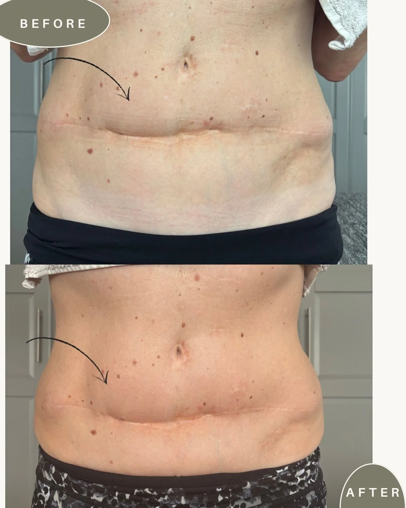 SCARS HOLD EMOTION AND TENSION ❤️

I&rsquo;ve been seeing more clients with different abdominal scars, including DIEP flap breast reconstruction following a mastectomy.

These scars are often connected to much more than the physical tissue&mdash;they