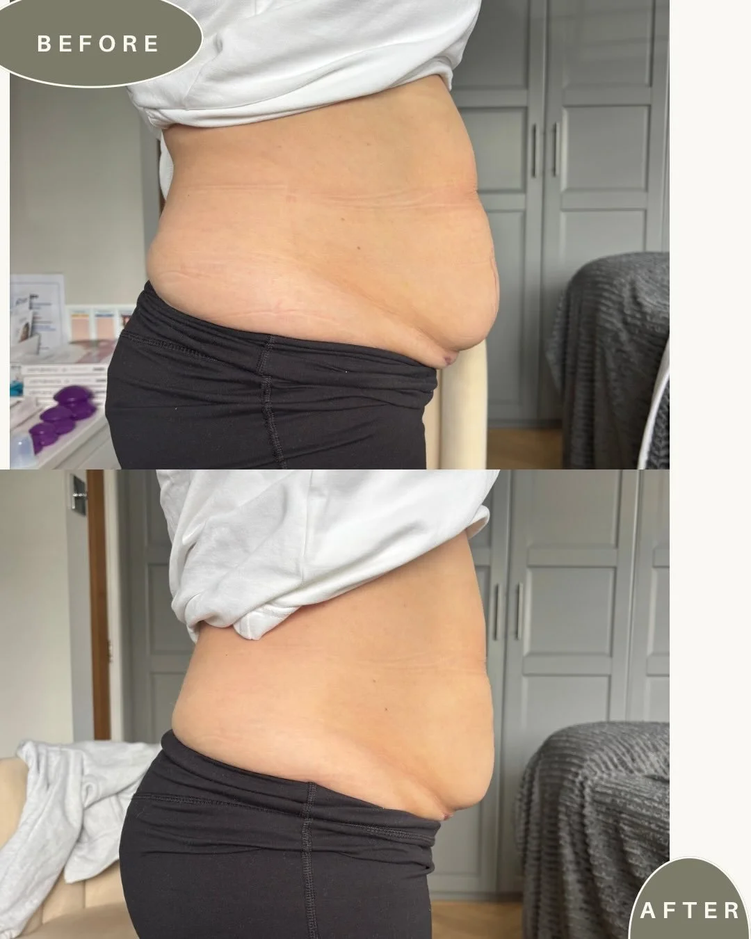 💫 LET&rsquo;S TALK ABOUT THE &ldquo;C-SECTION OVERHANG&rdquo;

Around 75% of the mums who come to see me are worried about their C-section &ldquo;shelf&rdquo; or overhang.

And I get it&hellip; mine bothers me too.

But here&rsquo;s the thing 👇

Th