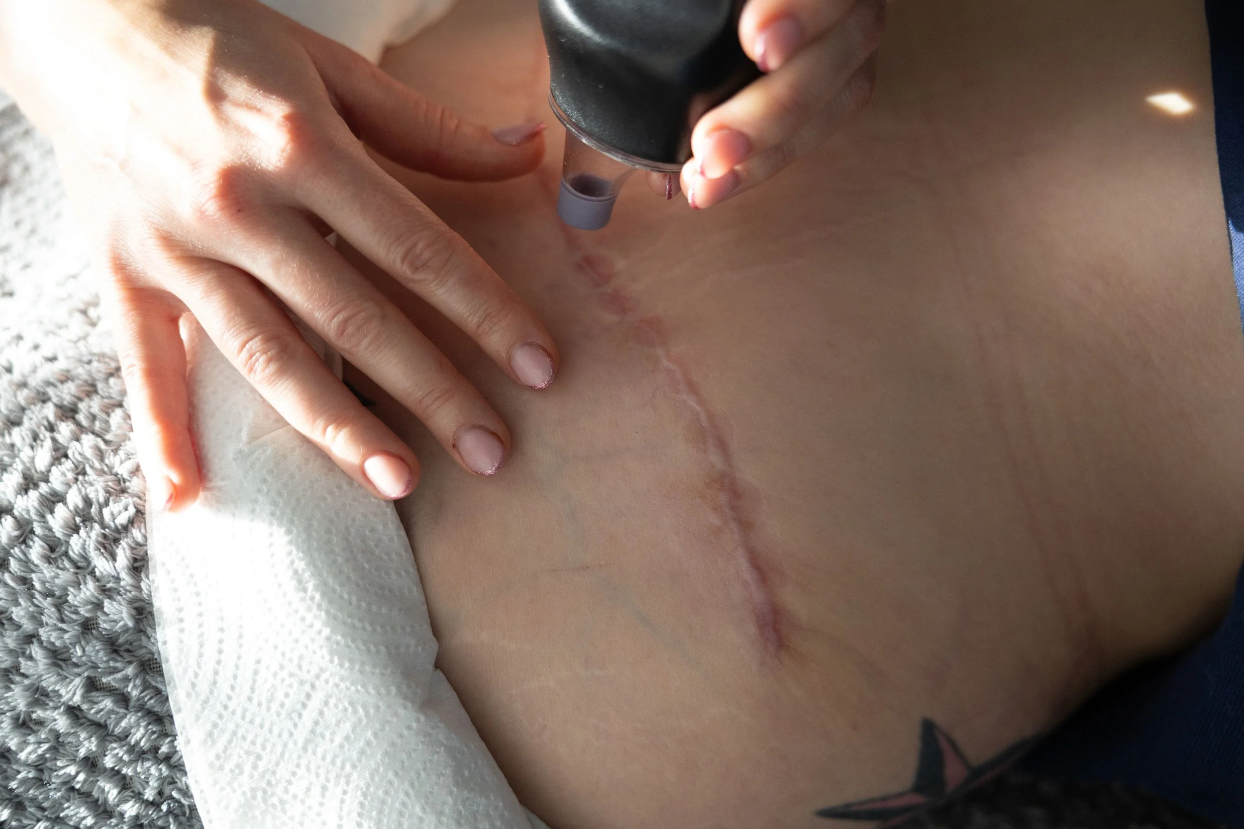 A person is having a surgical scar on their torso closed or treated with a device, with a hand resting on their skin near the scar.