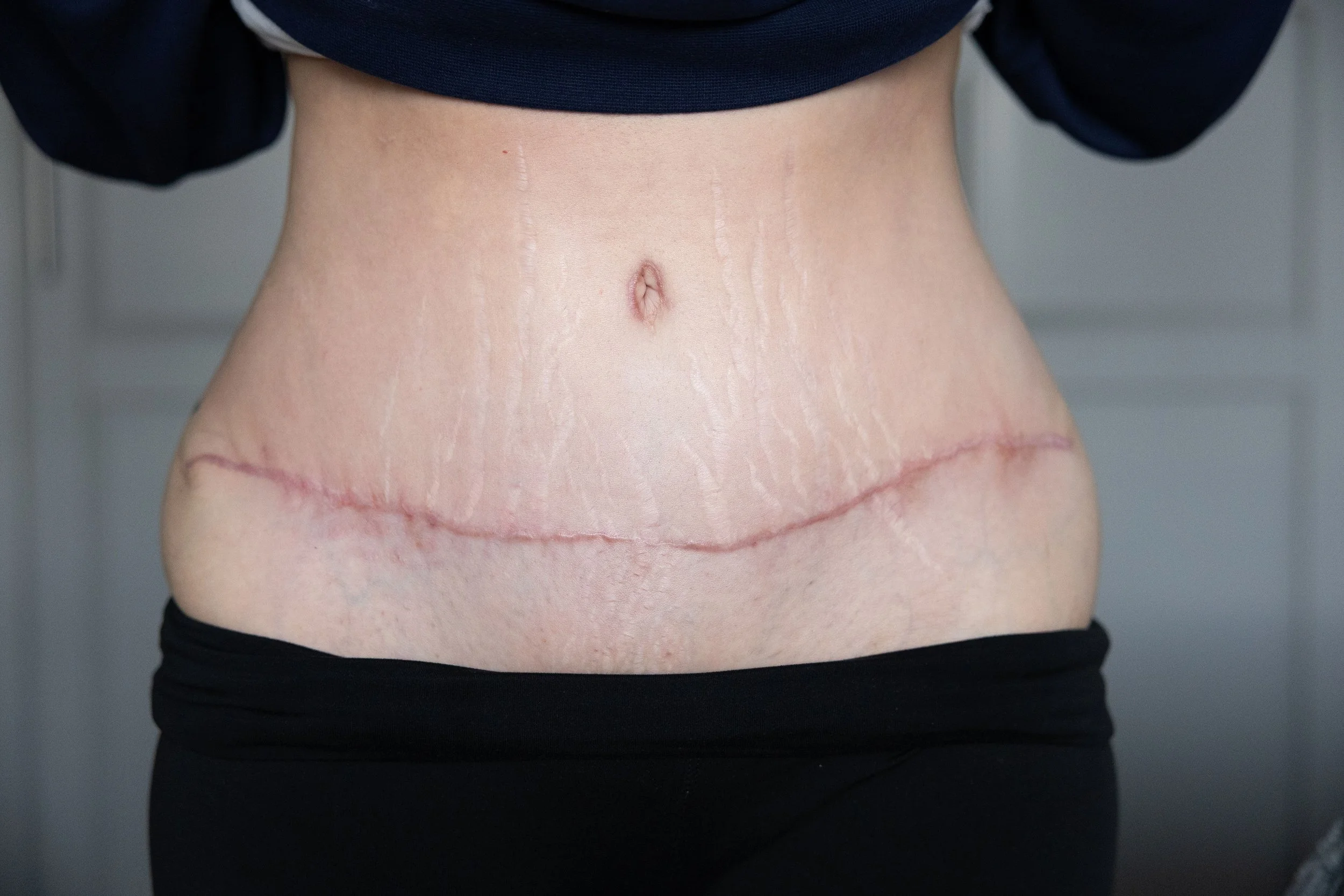 Person's lower abdomen showing a surgical scar from a recent procedure.