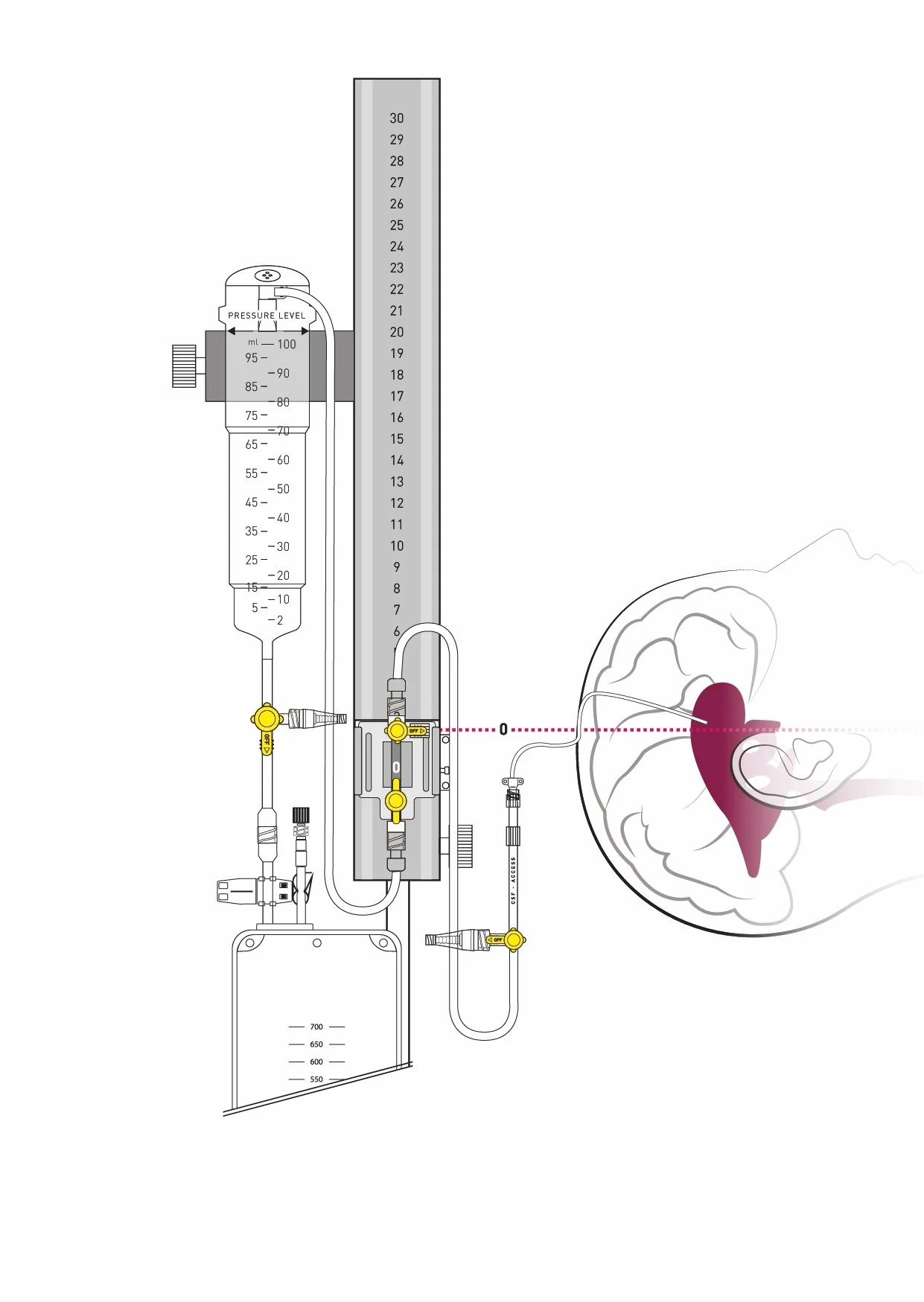 VentrEX® EVD technical view