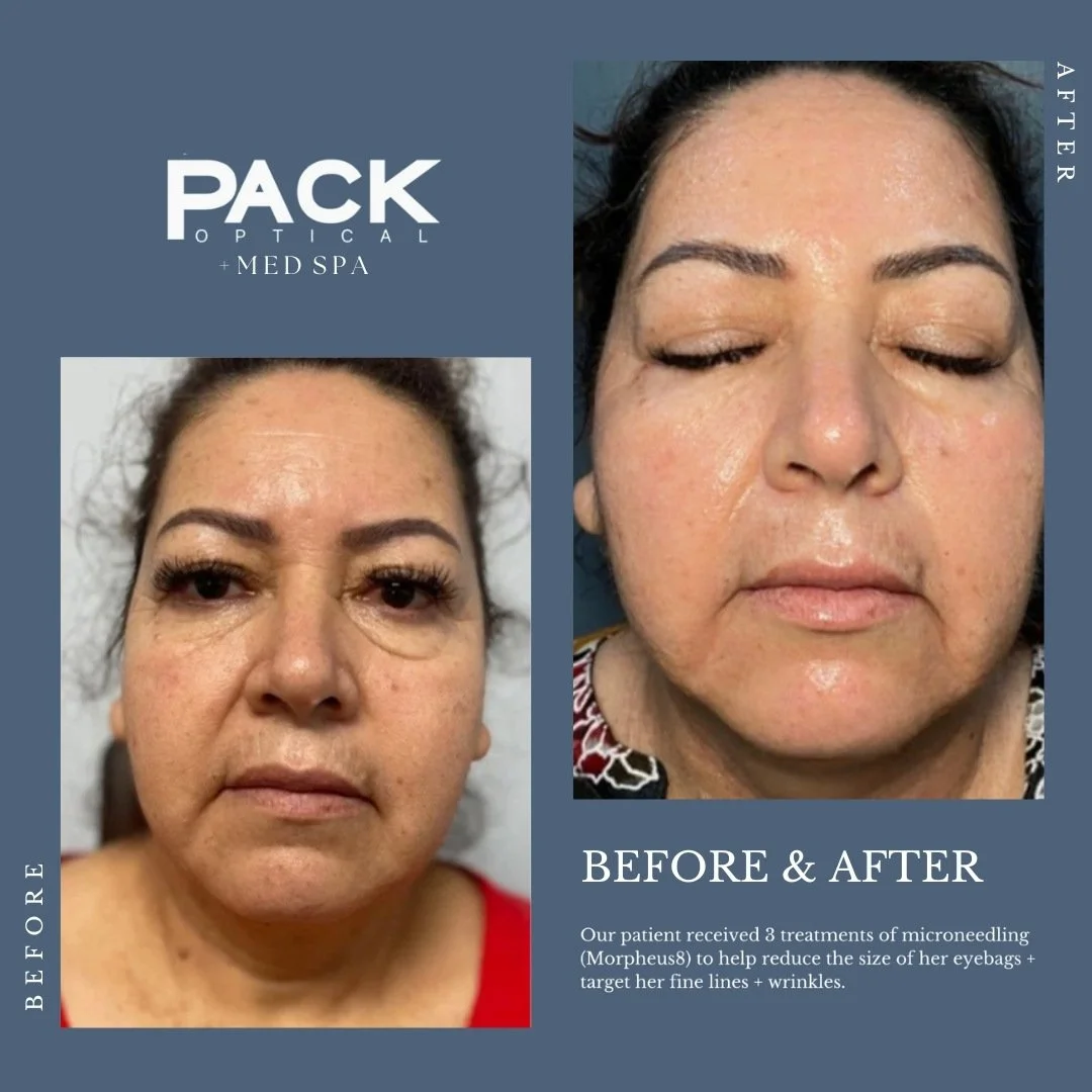 packoptical-aesthetics-before-and-after.jpg