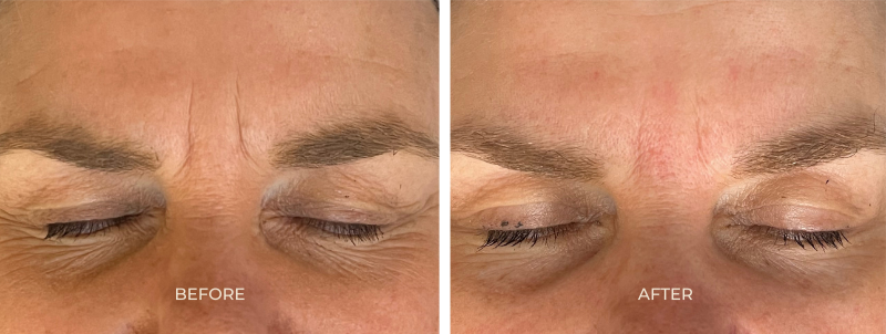 Before and after results after miso cosmetic acupuncture treatments - frown lines between eye brows have effectively softened and become lighter as well as under eye lines and wrinkles. Eyes have also been lifted.
