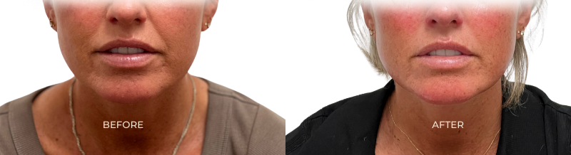 Before and after results after miso cosmetic acupuncture treatments, nasal labial line has effectively softened and cheeks are plumper and lifted.