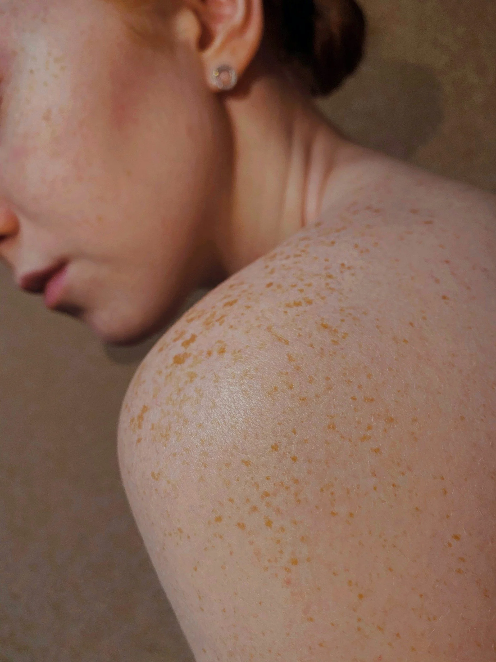 skin health clinic Kingscliff cosmetic injectables botox northern rivers fillers gold coast Visia skin analysis