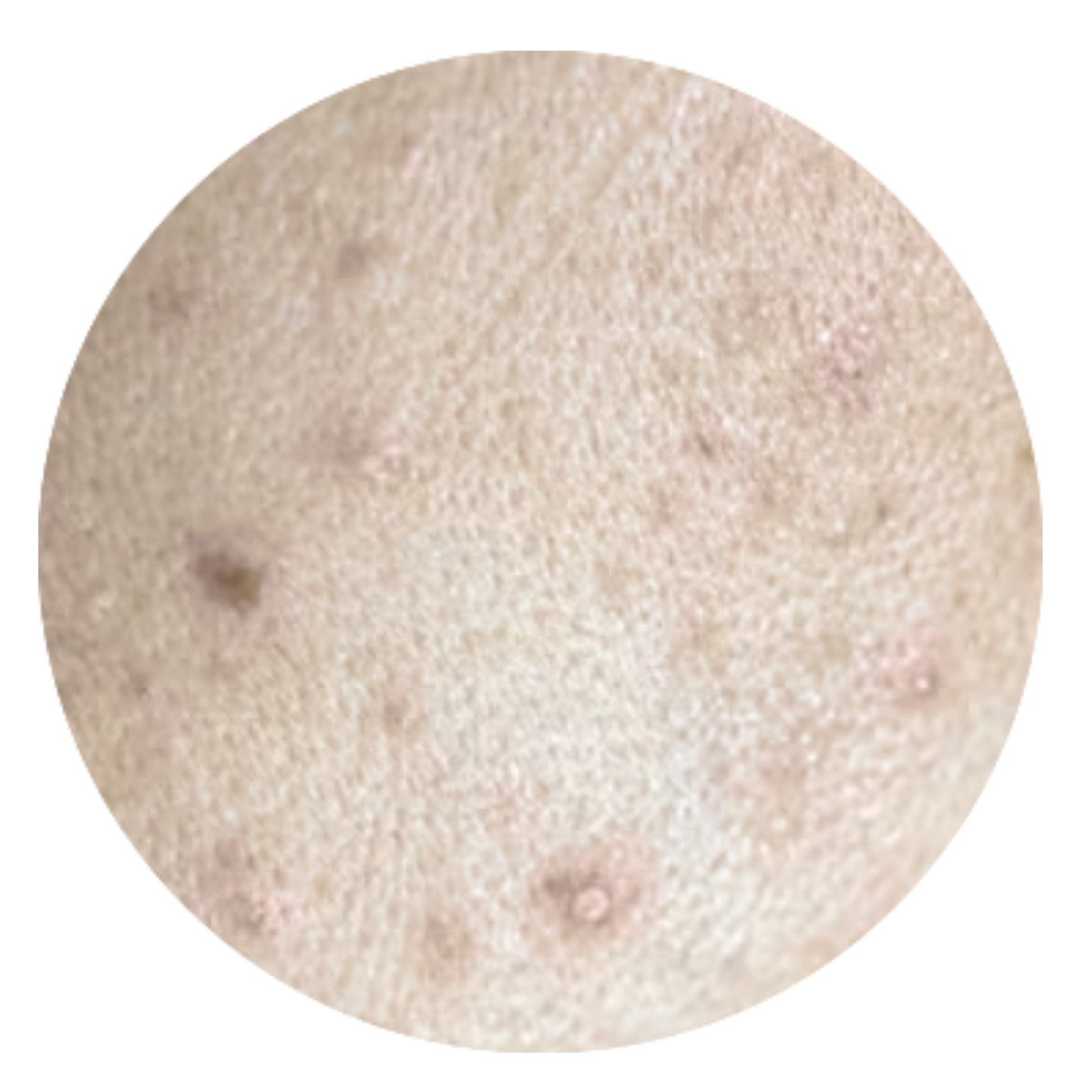 Acne Is a Medical Condition, Not a Superficial Cosmetic Concern