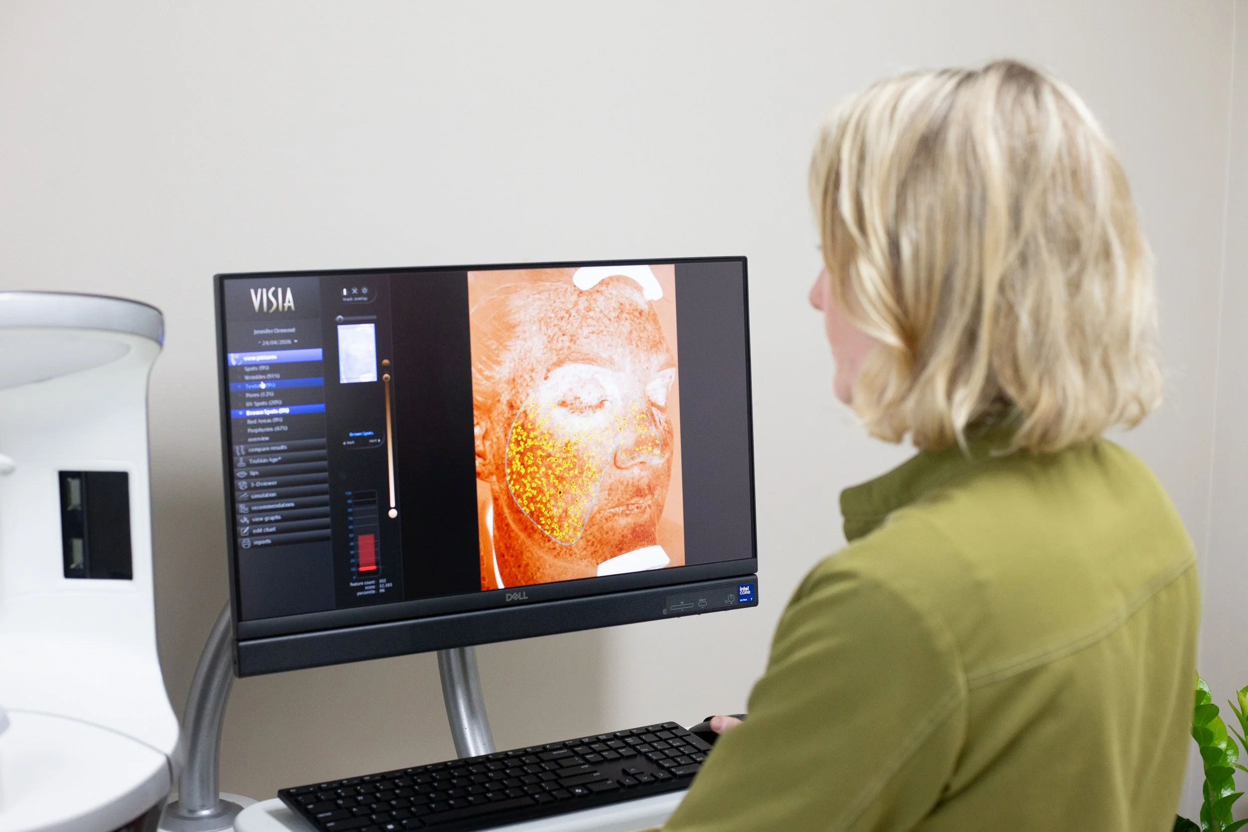 Nurse Practitioner examining skin analysis for an Acne consultation on the VISIA at the derm clinic Kingscliff