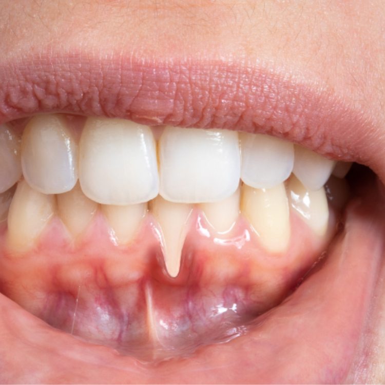 What is Soft Tissue Regeneration?