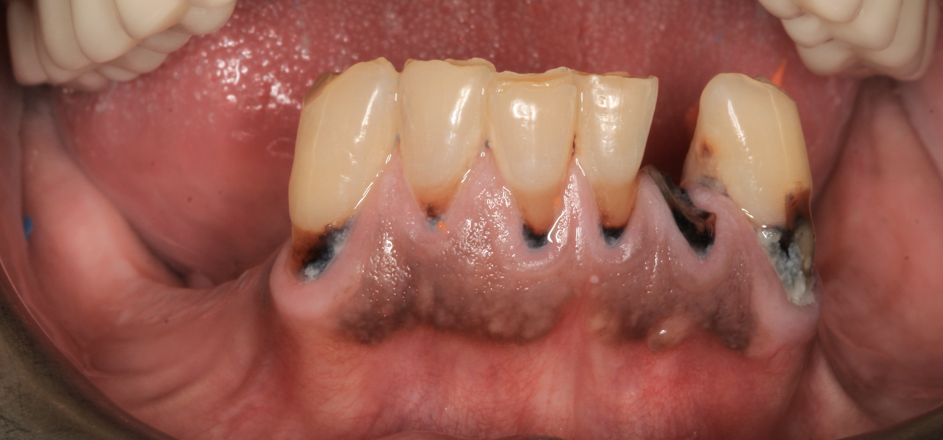 Immediate Implant Placement with GBR & Soft Tissue Regeneration