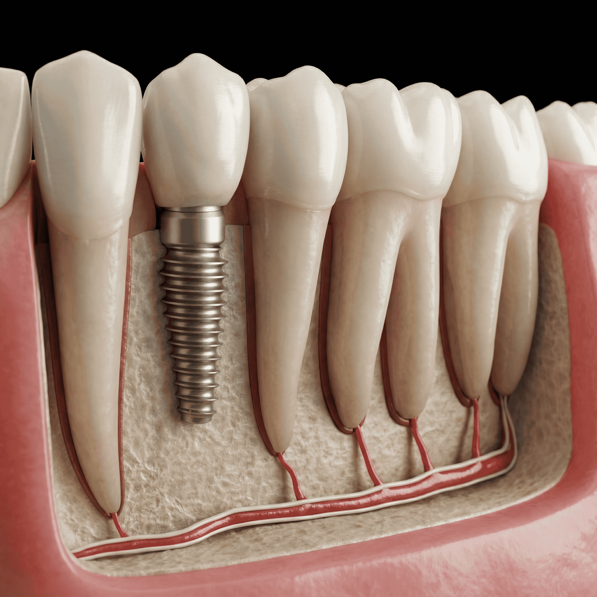 Dental Implant Example by Dr. Nik Vourakis - Oral Surgeon Harley Street London