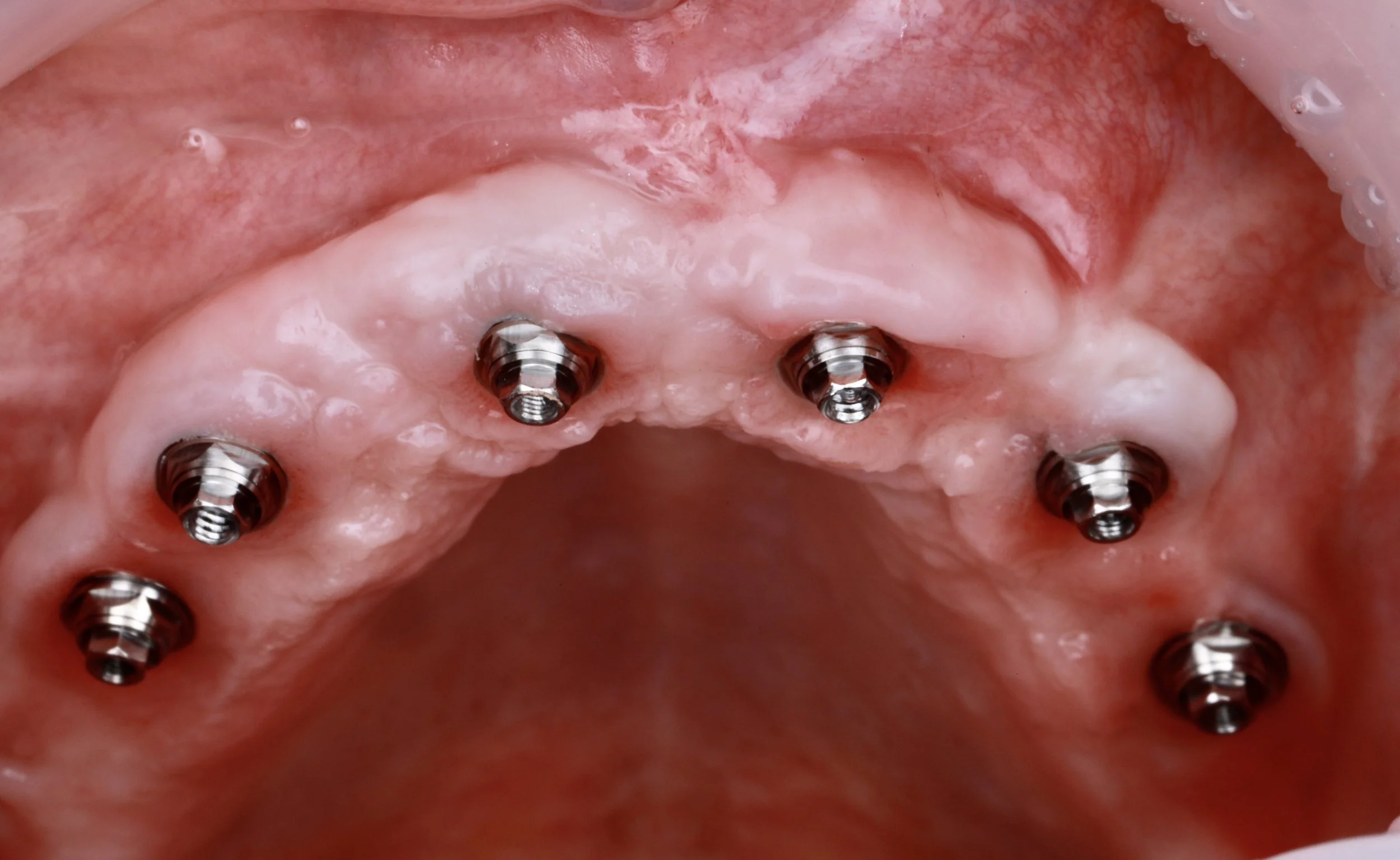 Guided Surgery