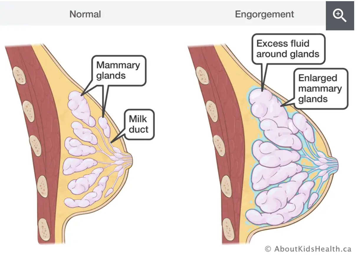 Breast Engorgement Relief: A Guide to Managing Pain and Swelling
