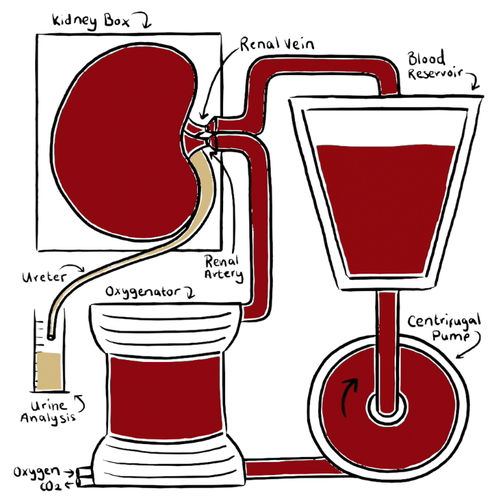 Diagram of a kidney dialysis machine showing the kidney, renal vein, renal artery, ureter, blood reservoir, oxygenator, and centrifugal pump.