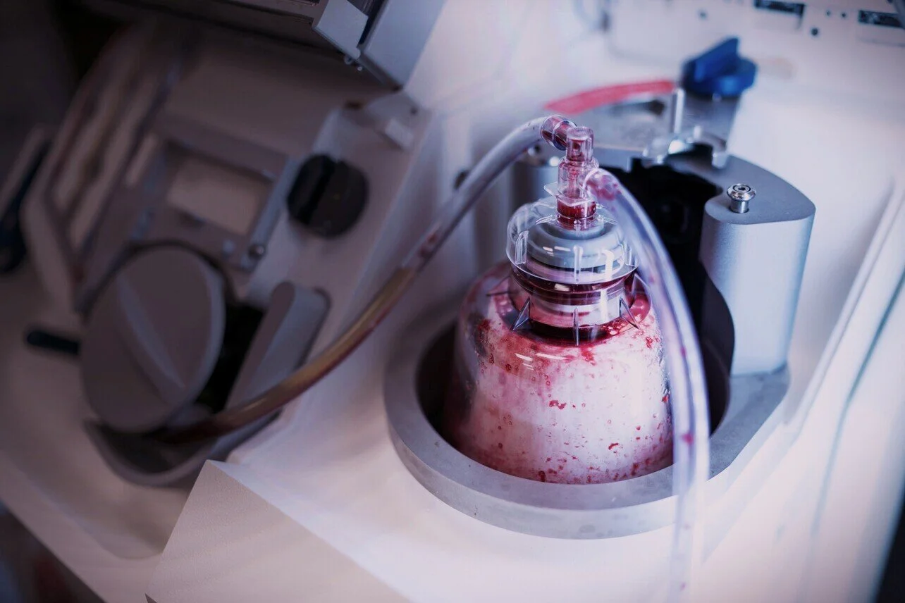 A medical machine with a blood-filled container connected by tubes, likely used for apheresis or blood processing in a healthcare setting.