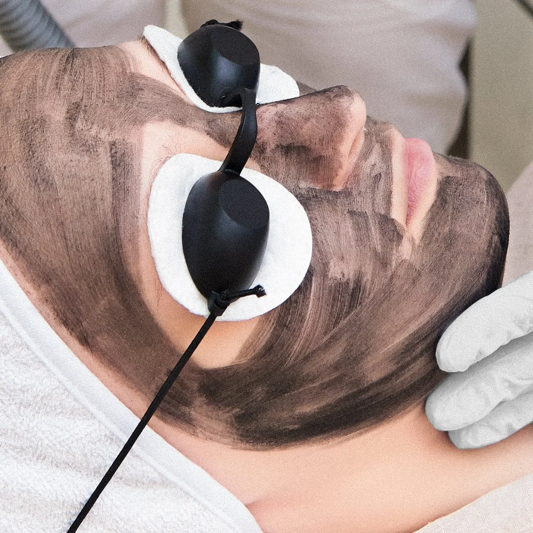 carbon hollywood laser facial with grey solution on skin and goggles