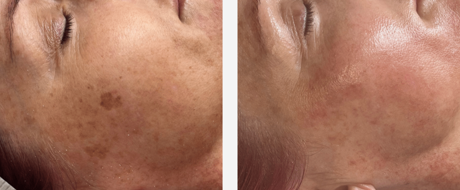 IPL pigmentation correction before and after