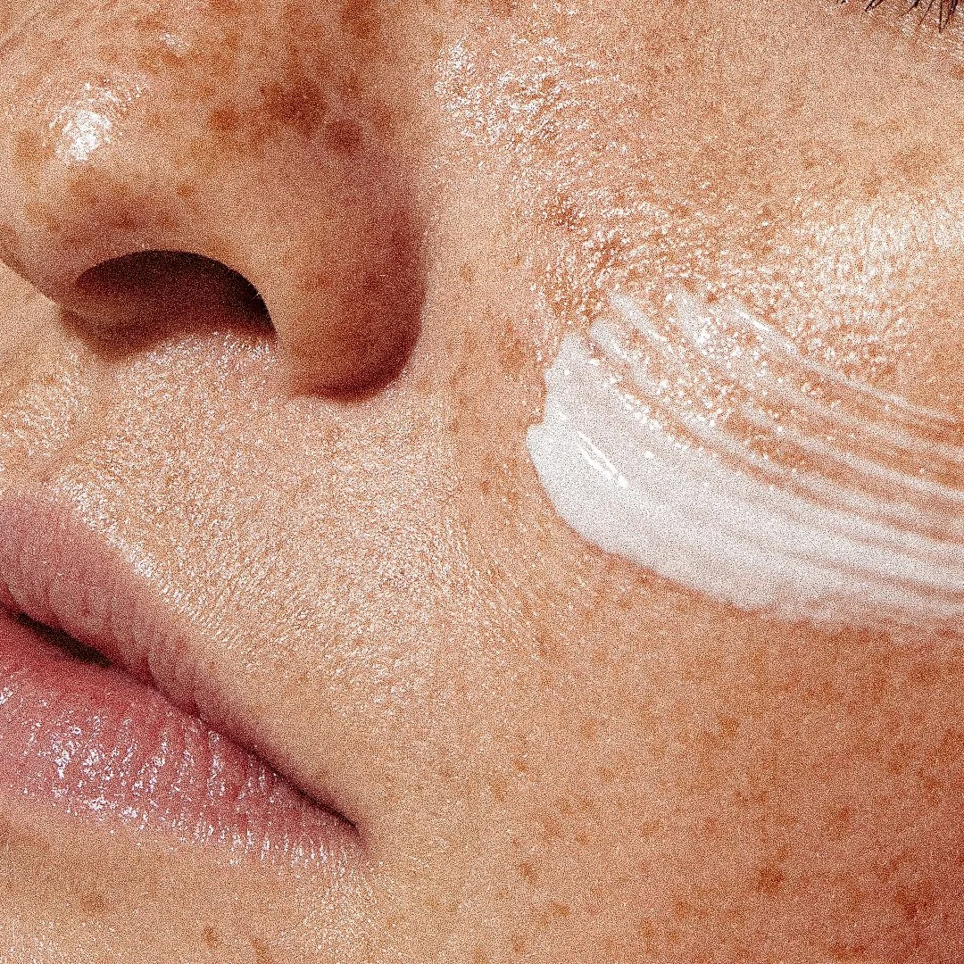 Sunspots &amp; hyper-pigmentation