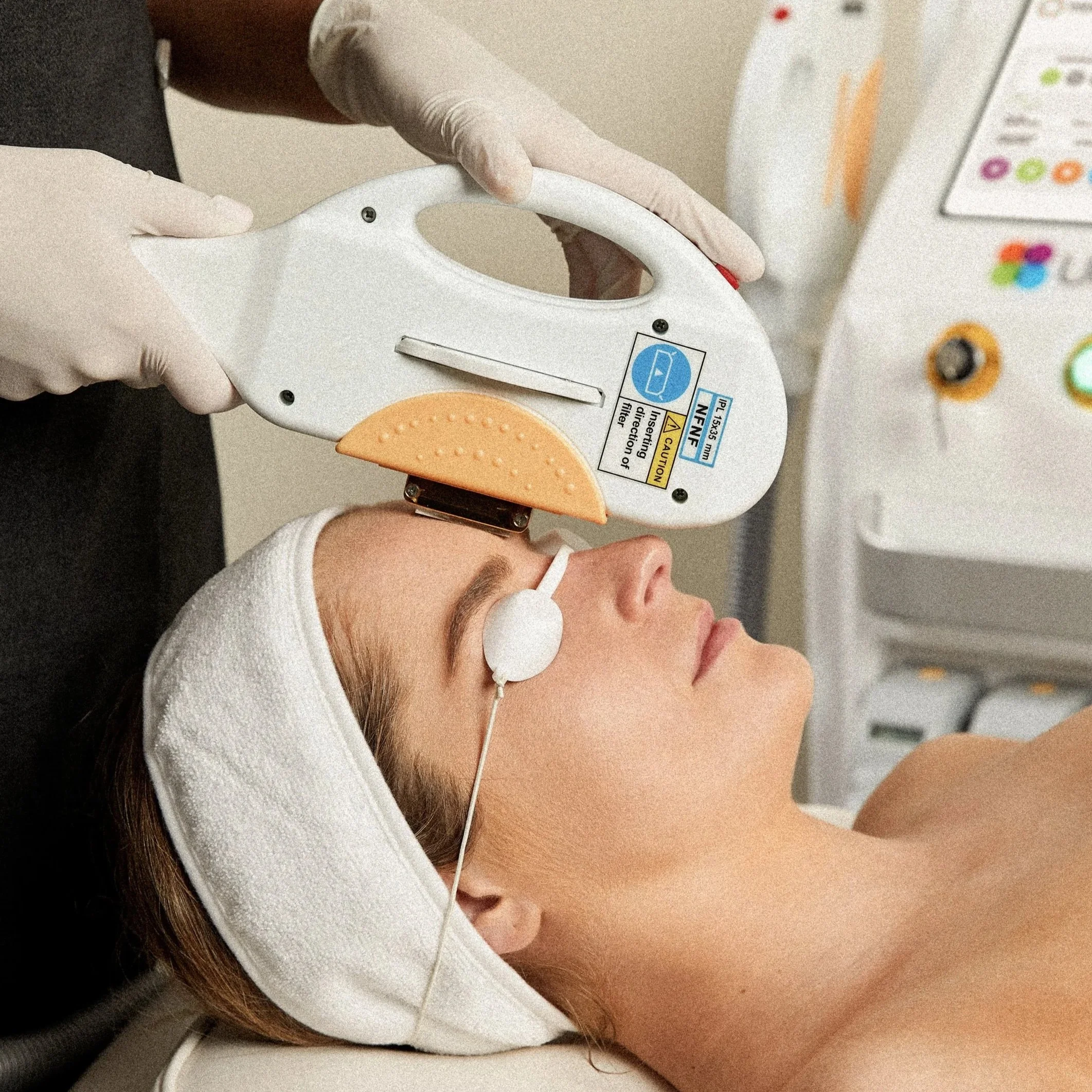 How IPL treats hyper-pigmentation