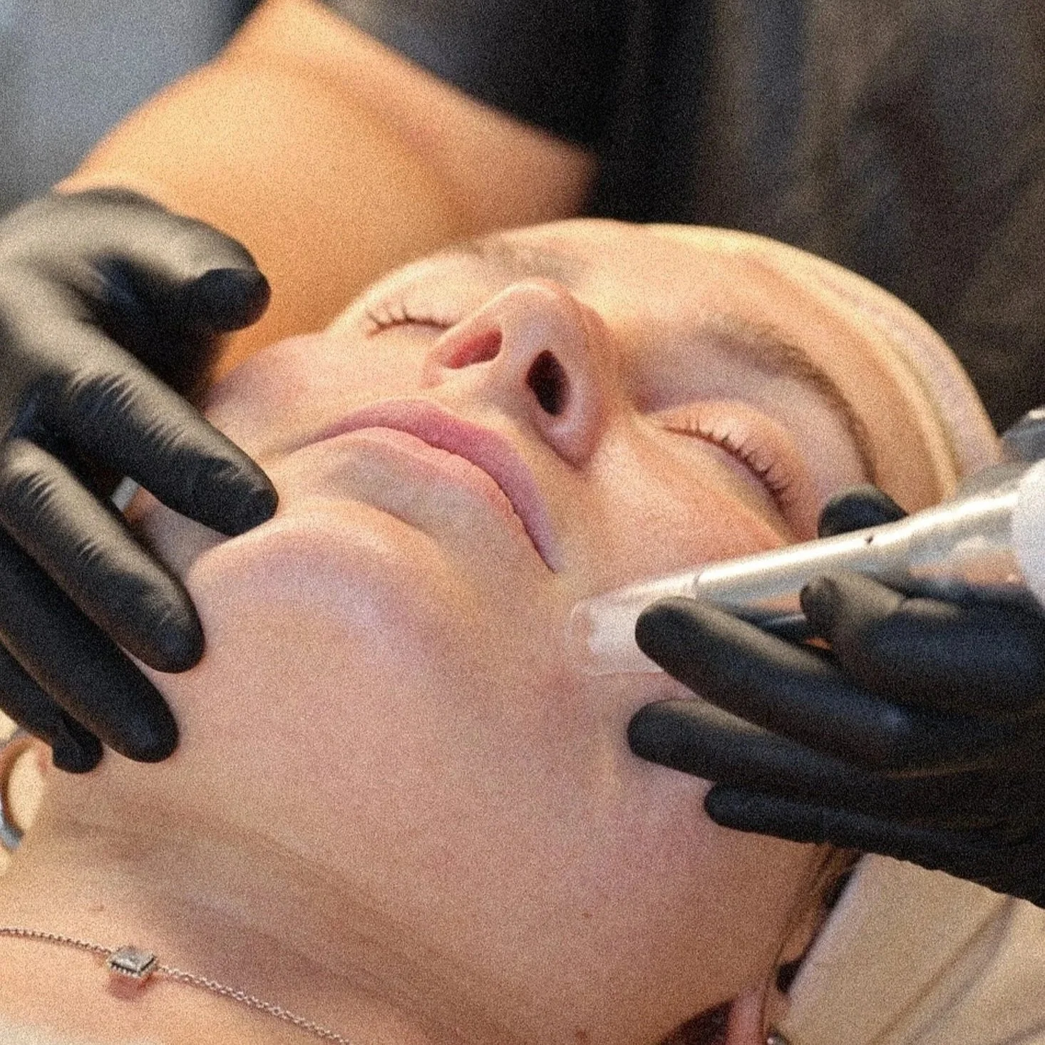 skin needling with PRP or growth factors for collagen induction using advanced XCellarisPRO TWIST device