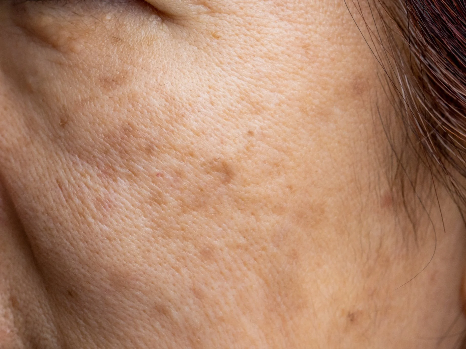 pigmentation spots and sun damage on cheek skin of middle aged woman