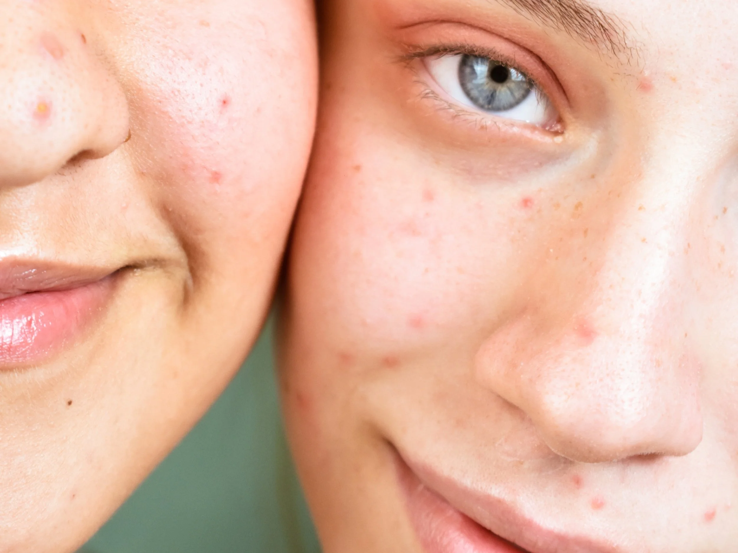 happy teenagers showing blue ipl light for acne bacteria