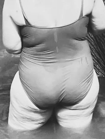 vrouw met lipoedeem zware benen