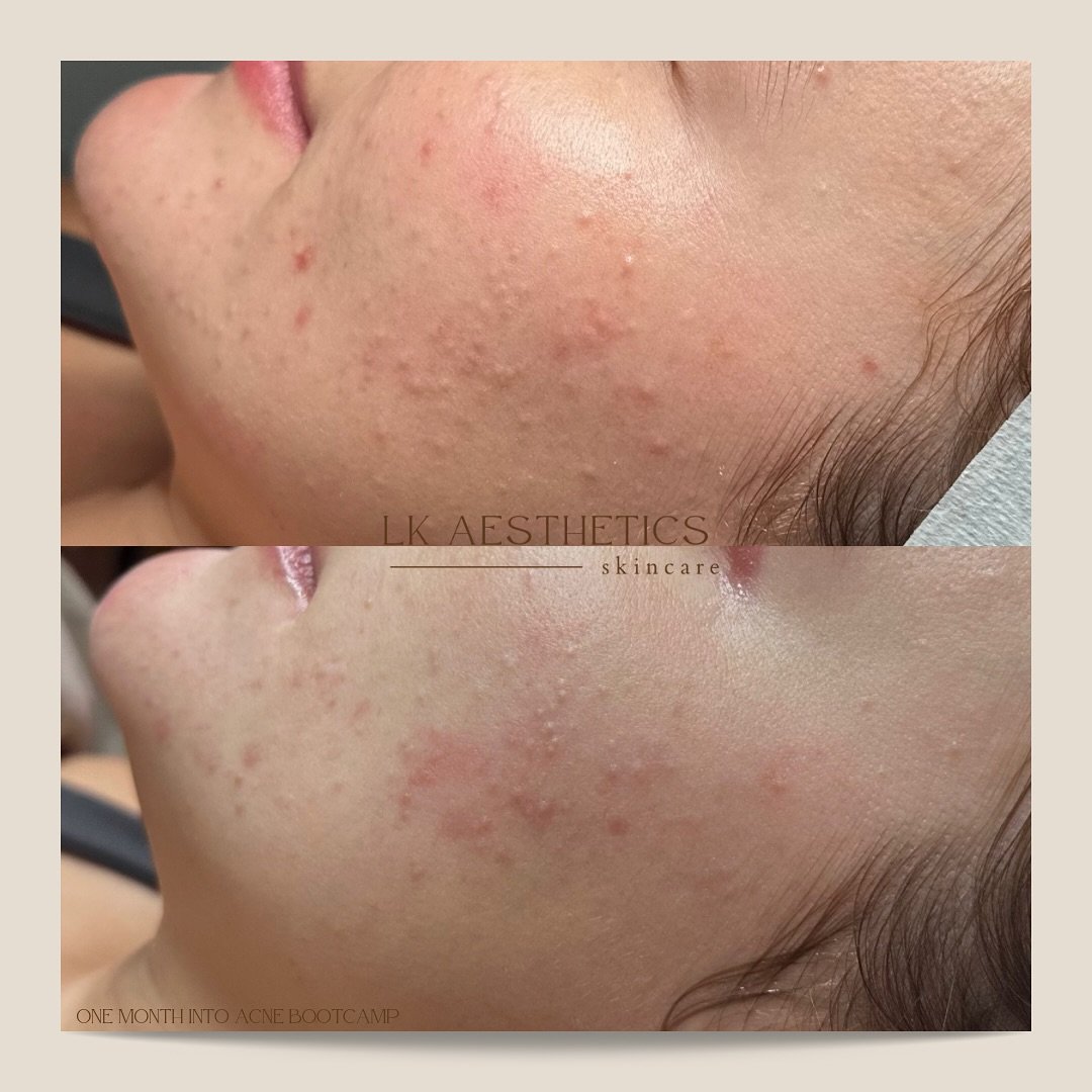 😚 30 days apart, the way my jaw dropped with these results

It&rsquo;s only been ONE month of being on a regimented routine along with a couple of in-clinic treatments 🔥

These results were achieved with no prescription topicals or medication. It o