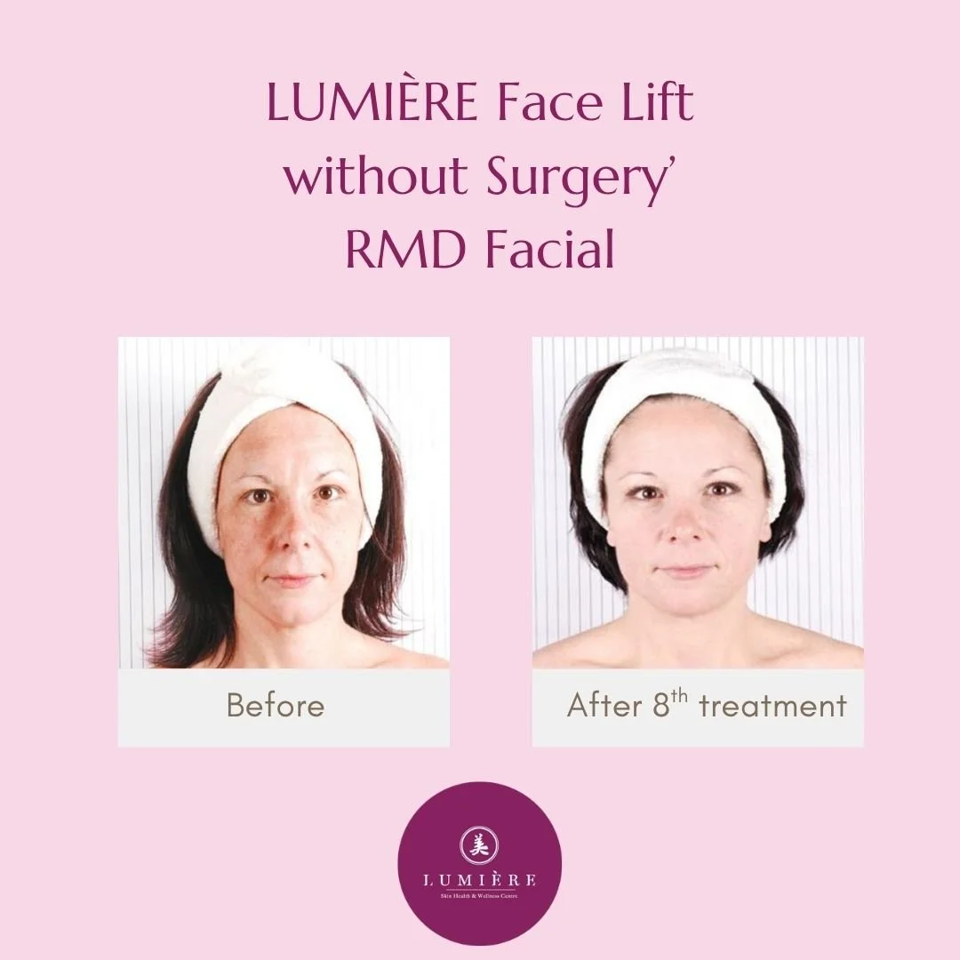 38 YO After 8 Treatment.jpg