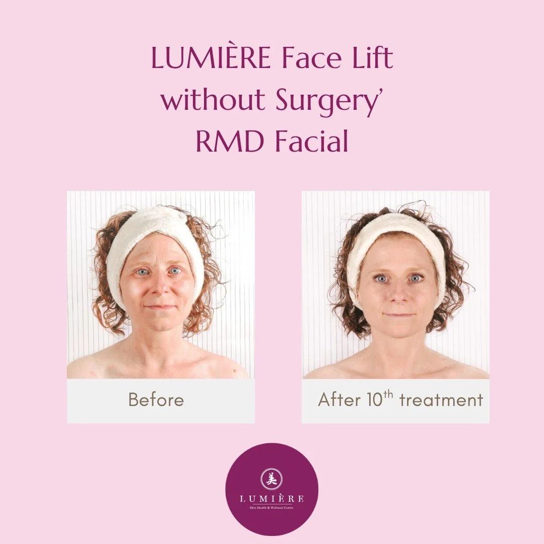 40 YO After 10 Treatment.jpg