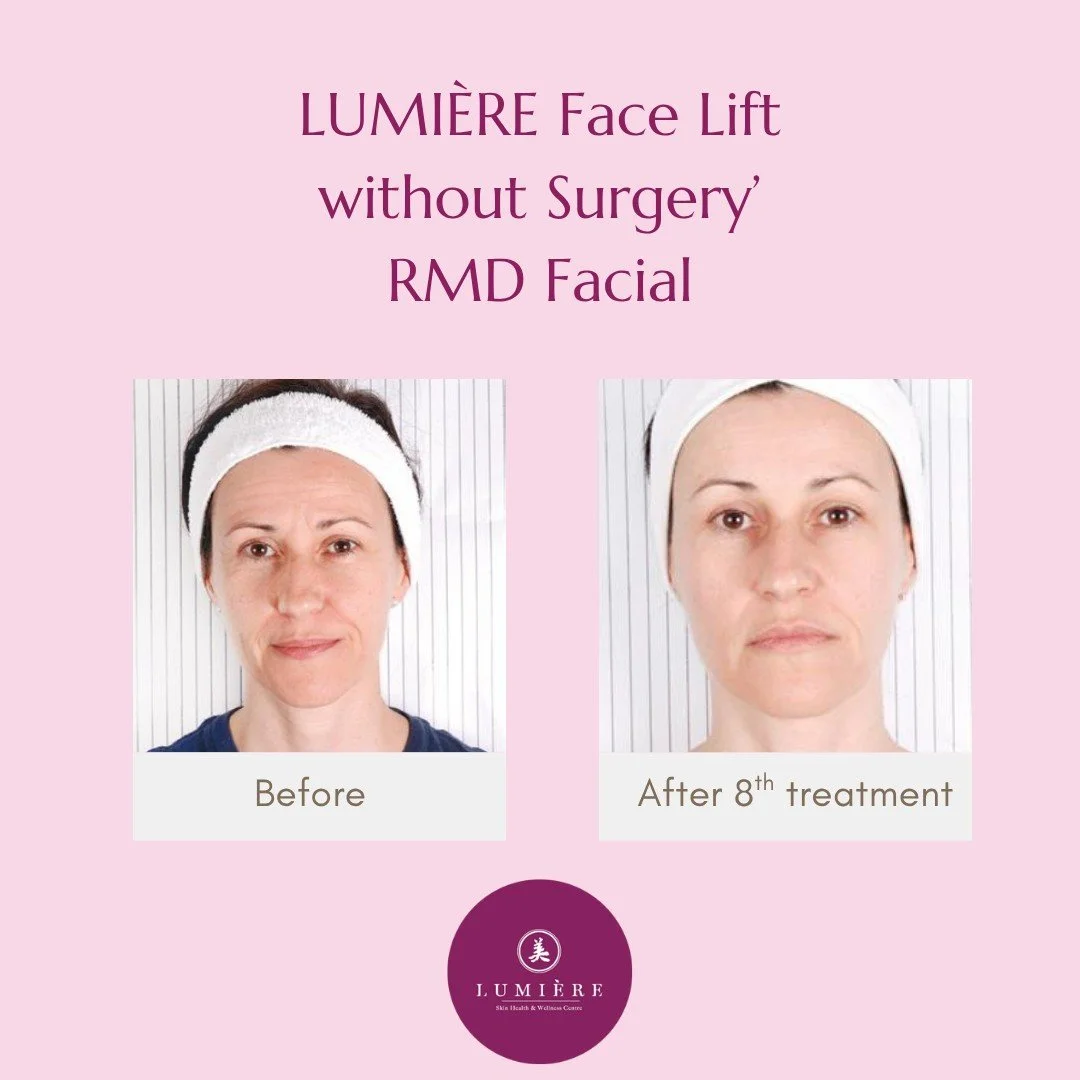 43 YO After 8 Treatment.jpg