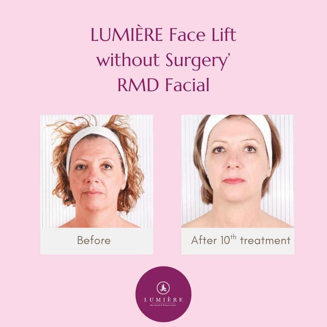 48 YO After 10 Treatment.jpg