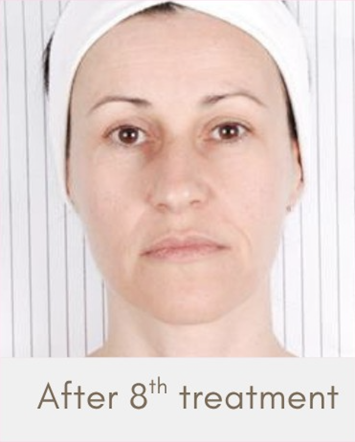 Close-up of a woman with minimal makeup, wearing a white headband, in front of a white, striped background, with text that reads 'After 8th treatment'.