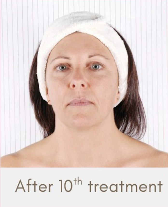 A woman with light skin and blue eyes wearing a white headband, showing her face and shoulders, with a neutral background. The text below states 'After 10th treatment.'